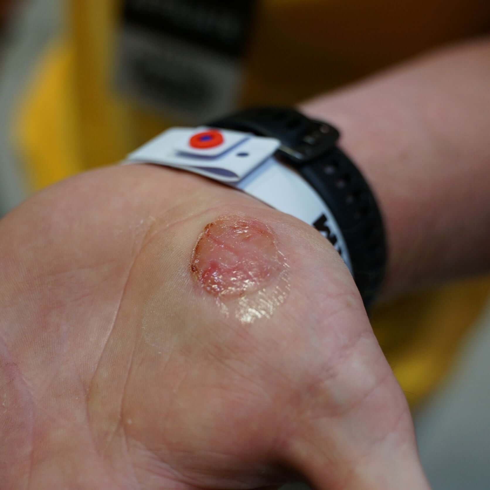 Rip Repair Skin Protectant applied on a healing abrasion on a person's palm, demonstrating skin protection after injury.